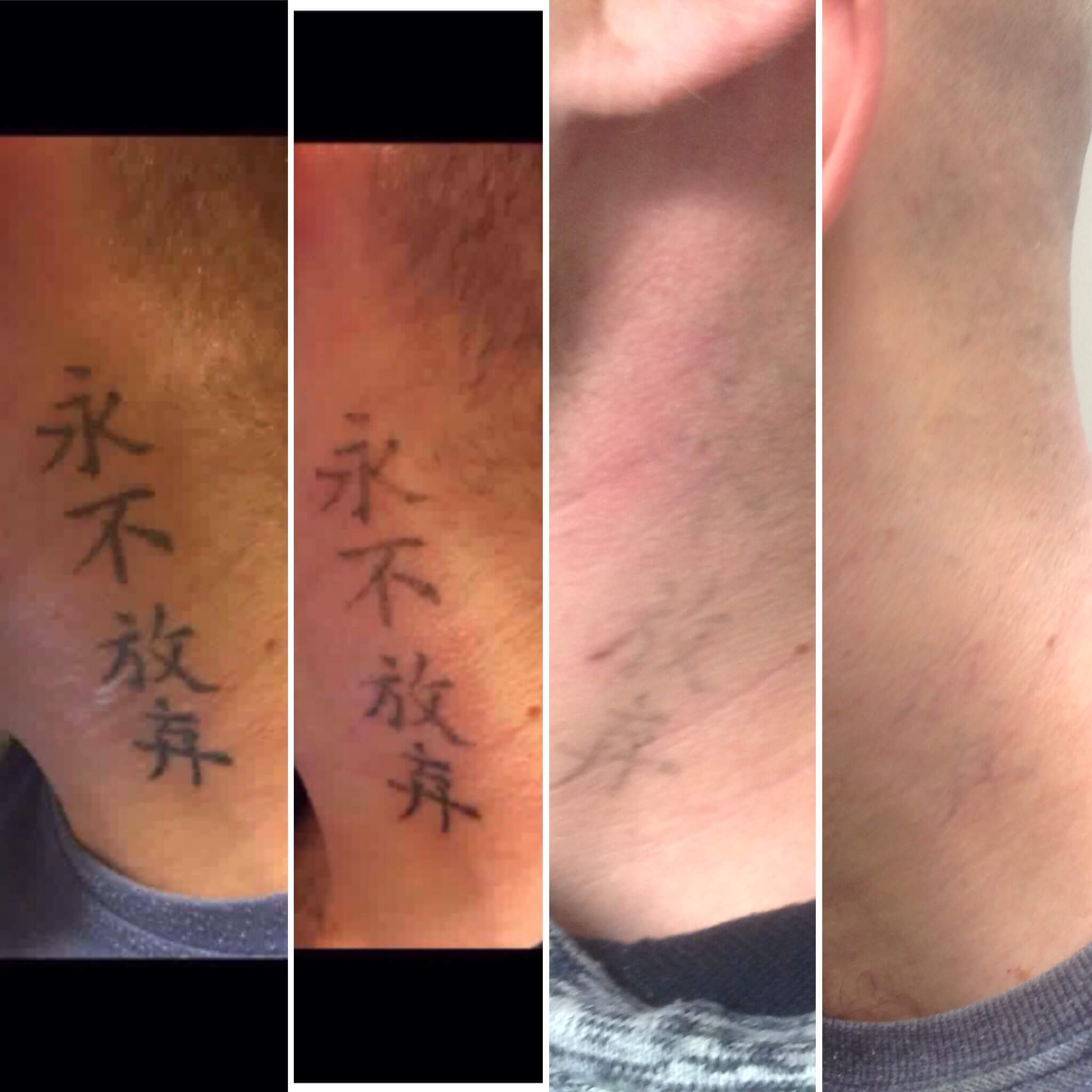 Laser Tattoo Removal St James Tattoo Removal